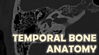 Anatomy of the Temporal Bone on Imaging [upl. by Esmond620]