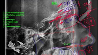 11Kim Analysis Cephalometric analysis [upl. by Tiffanie]