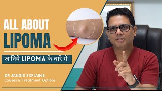 All About Lipoma  What are the causes and treatment options for Lipma  Lipoma Surgery in Delhi [upl. by Rawdin702]