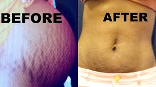 HOW TO GET RID OF STRETCH MARKS [upl. by Nosduj]