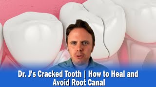 Dr Js Cracked Tooth  How to Heal and Avoid Root Canal [upl. by Jestude]