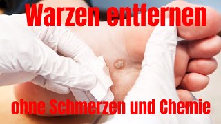 So können Sie Warzen selber entfernen ohne Schmerzen oder Chemie [upl. by Ydoc180]