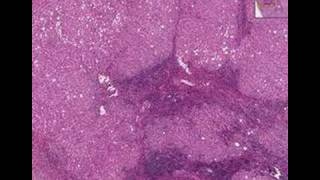 Histopathology LiverChronic active hepatitis cirrhosis [upl. by Annayoj]