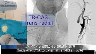 橈骨動脈アプローチ頚動脈ステント transradial CAS [upl. by Pisarik]