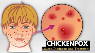 Chickenpox Causes Signs and Symptoms Diagnosis and Treatment [upl. by Elleuqram728]