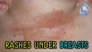 Home remedies to treat the rashes under the breasts [upl. by Donell724]