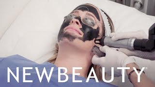 The Carbon Laser Peel IS the Secret to Better Skin in 20 Minutes  NewBeauty [upl. by Ahtiuqal]