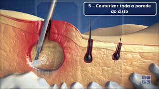 EPSIT Endoscopic Pilonidal Sinus Treatment  Tratamento Endoscópico do Cisto Pilonidal [upl. by Halullat]