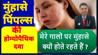 मुंहासे पिंपल्स की होम्योपैथिक दवा और इलाज  Homeopathic medicine for Acne Pimple in hindi [upl. by Codie173]