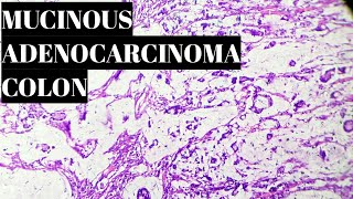 Mucinous Adenocarcinoma Colon Histopathology [upl. by Mayes]