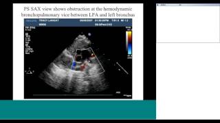 Echo assessment of normal and abnormal pulmonary venous drainage by Dr Sivakumar [upl. by Kantos]