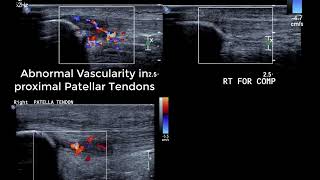 Knee Ultrasound basics  dynamic tests for anterior knee and ITB amp identifying collateral ligaments [upl. by Leonanie]