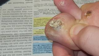 Plantar wart removing part 2  Dornwarze entfernen Teil 2 [upl. by Rasla]