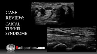 Ultrasound of Carpal Tunnel Syndrome [upl. by Ellehcer]