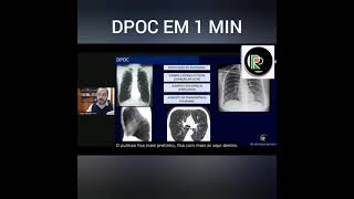 Sinais de DPOC na Radiografia de Tórax Hiperinsuflaçâo Pulmonar mini revisão [upl. by Seana]