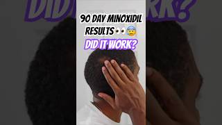 Minoxidil Before And After  Is 3 Months Enough  90 Day Results👀😥 [upl. by Ettezel]