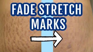 7 ways to fade stretch marks Dr Dray [upl. by Hadlee710]