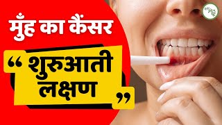 Signs of oral cancer Hindi [upl. by Eugenia]