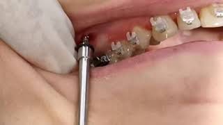 IZC screw Infra Zygomatic Crest TAD insertion of IZE mini screw IZC orthodontic mini implant [upl. by Burr]