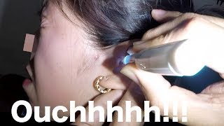 Girls Complete Earwax Buildup Removal Now She can hear colors [upl. by Kathye]