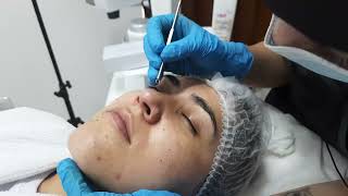 Limpieza facial profunda  Vitti medical  cuidado facial  tratamientos faciales [upl. by Arfihs689]