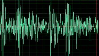 Aortic Regurgitation slow [upl. by Ama]