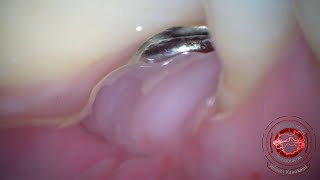 AUMENTO de encía queratinizada en implantes con injerto gingival libre [upl. by Moriarty893]