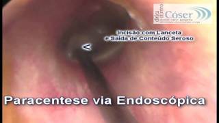 Paracentese Timpânica via EndoscópicaTympanic Paracentesis Otoendoscopic technique [upl. by Langham319]