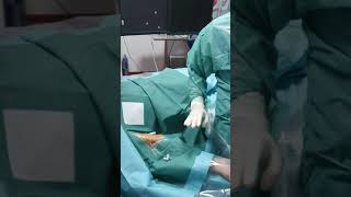 Embolisation varicocèles stade 3 l العلاج بالقسطرة دوالي الخصية الدرجة ثلاثة [upl. by Ativad]