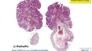 Adenoidectomy  actual footage [upl. by Vic]