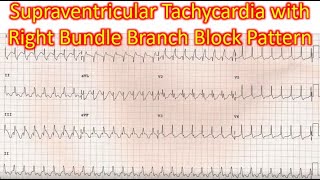 Supraventricular Tachycardia with Right Bundle Branch Block Pattern [upl. by Anyahs517]