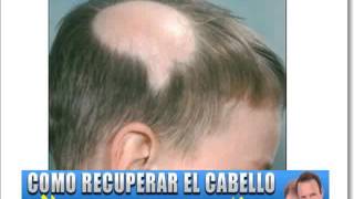 Caida del Cabello en Niños [upl. by Naejarual]