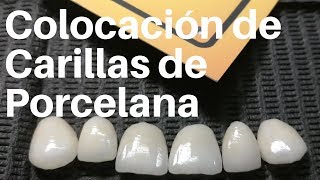 COLOCACIÓN de CARILLAS de Porcelana👅carillasdentales [upl. by Aicert121]