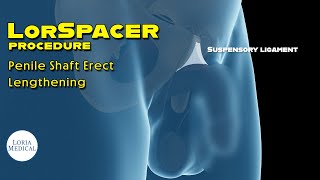 Suspensory Ligament Release procedure How its done [upl. by Fitzger257]