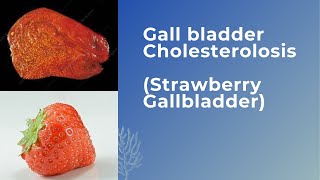 Gall bladder cholesterolosis Strawberry Gallbladder [upl. by Tempa833]