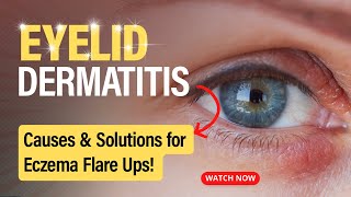 Eyelid Dermatitis Uncovered Causes and Solutions [upl. by Bouchard]