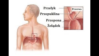 Przepuklina rozworu przełykowego – Jak ją leczyć [upl. by Lourdes]