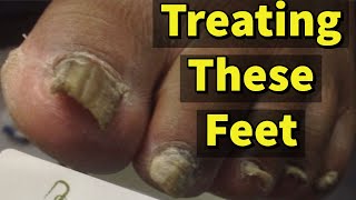 Treating These Feet A Patient With Fungal Toenails [upl. by Mcmurry]