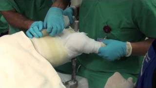 How to apply a walking onelegged hip spica cast —paediatrics trauma— educational video for surgeons [upl. by Evilo]