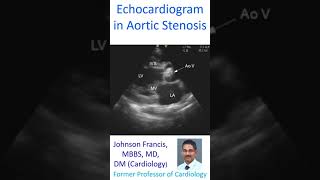 Echocardiogram in Aortic Stenosis [upl. by Getraer]