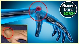 How To Get Rid of Ganglion Cysts Naturally At Home Painful Bump on Wrist [upl. by Hemminger]