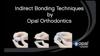 Indirect Bonding by Opal Orthodontics [upl. by Yaras]