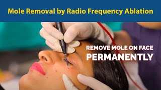 Mole Removal by Radio Frequency Ablation Remove mole on face permanently  Dr Jyoti Gupta MD [upl. by Cornwell]