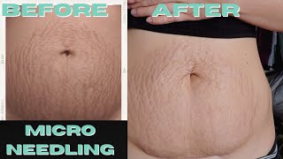 I Got Professional Microneedling Done on my Stretch Marks Results and What to Expect [upl. by Oliric]