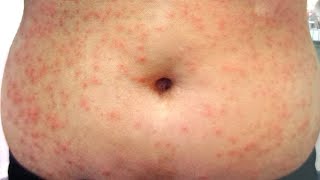 Miliaria Heat Rash  All 3 types  How to treat [upl. by Ahc966]