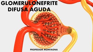 GLOMERULONEFRITE DIFUSA AGUDA [upl. by Brunhilde]