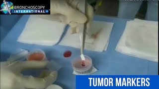 Tumor Markers and EBUS [upl. by Takeo]