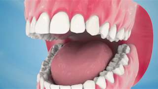 Dental Implant Procedure [upl. by Delila]