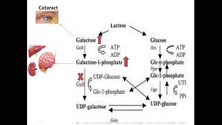 Galactosemia Galactose metabolism disorder [upl. by Ronyar]