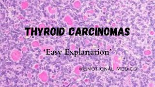 Thyroid Carcinomas  Introduction  emotionalmedico [upl. by Cobbie455]